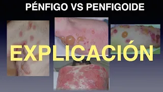 Pénfigo vs Penfigoide: Comparativa