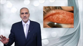 Elbromboly Basic ophthalmology IC Conjunctiva Conjunctivitis