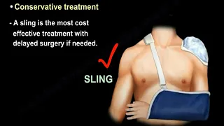 Clavicle Fractures, symptoms,  types, diagnosis and  treatment with  surgery and without surgery.