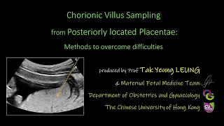 CVS from Posteriorly located Placentae:  Methods to overcome difficulties | OBG CUHK