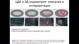 УЗИ патологии эндометрия.Видеолекция