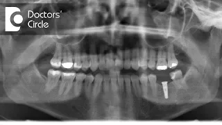 Are Dental Implants safe for MRI?- Dr. Sharon Colaco Dias