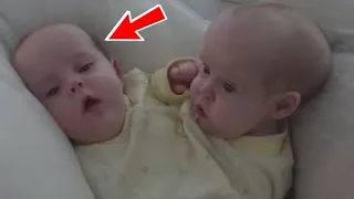 The conjoined twins were separated in 2006. You will be shocked, this is how they live today