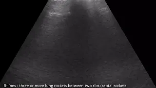 CASE 593 LUNG ULTRASOUND INTERSTITIAL PNEUMONITIS B LINES