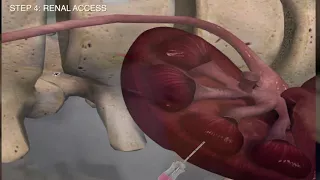 Complete Supine Percutaneous Nephrolithotomy - STEP by STEP technique