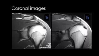 Shoulder Imaging part 1   Anatomy & Rotator cuff pathology   Dr Mamdouh Mahfouz