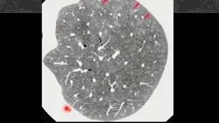 diffuse lung disease part 1