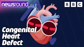 Congenital Heart Defect: How the NHS Has Helped Me | NHS 75 | Newsround