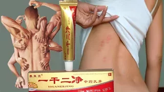Работает ли Китайская медицина? Мазь от дерматита, псориаза, экземы и прочих кожных заболеваний.