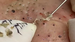 Removal Hidden Blackheads At Loan Nguyen Spa | 11