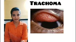 "Trachoma” detail explanation from A K Khurana