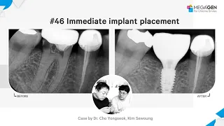 Dr. Yongseok CHO, Sewoung KIM, #46 Immediate implant placement surgery and prosthesis