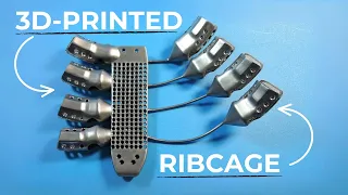 Cancer patient receives 3D printed ribs manufactured by Anatomics