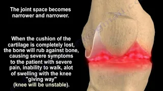 Knee arthritis symptoms and treatment - Everything You Need To Know - Dr. Nabil Ebraheim