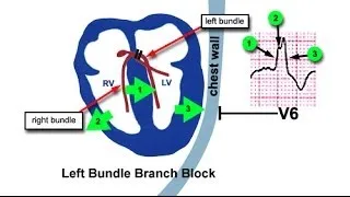 LBBB