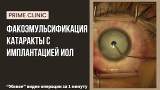 Факоэмульсификация катаракты с имплантацией ИОЛ -  видео операции за 1 минуту