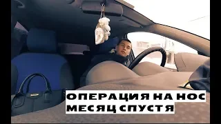 Операция на нос спустя месяц. Делюсь ощущениями.