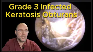 INFECTED GRADE 3 KERATOSIS OBTURANS - PART 1 OF EPISODE 200 #ear #earwax #earwaxremoval #earcleaning