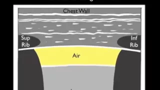 How To: Ultrasound for Pneumothorax Case Study Video