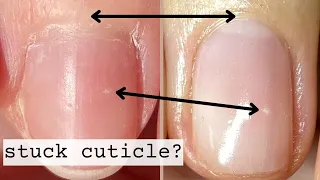 How to Correct Stuck Skin Around The Nails  [3 Week Progress]