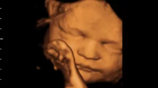 3D/4D ultrasound at 31 weeks GoldenView Ultrasound