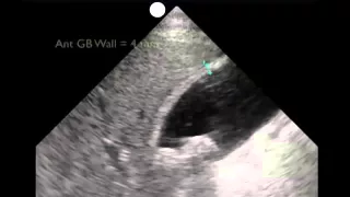 How To: Gallbladder Ultrasound Part 3 - Acute Cholecystitis Case Study Video