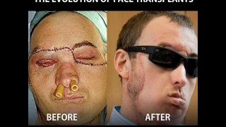 The Evolution of Face Transplants