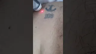 tattoo removal using Spectra