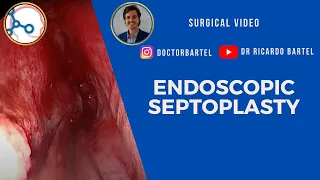 Endoscopic septoplasty for septal deviation