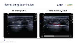 Lung Ultrasound in Patients with COVID 19 Disease