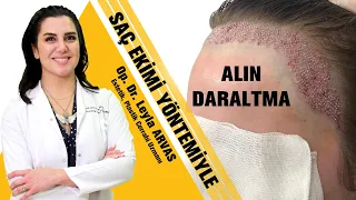 Saç Ekimi ile Alın Daraltma | Geniş Alın Daraltma | Saç Ekimi