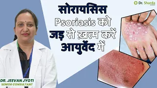 Psoriasis Treatment with Ayurveda | How to Get Rid of Psoriasis Naturally | Dr. Sharda Ayurveda