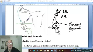 Hernia in Arabic 12 ( Indirect Inguinal hernia , part 3 ) , by Dr. Wahdan