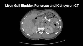 Anatomy of the Liver, Gall Bladder, Pancreas and Kidneys on CT