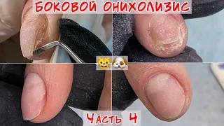 Онихолизис ногтей двухлетней давности / Три месяца спустя / Часть 4