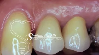 🇮🇹DENTAL IMPLANT CENTER NET🇮🇹 Dr Stefano Carelli | I vantaggi dell'implantologia conometrica