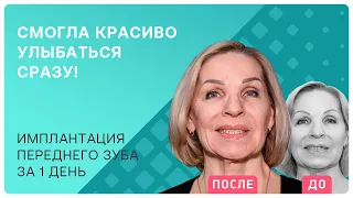 Отсутствие переднего зуба – катастрофа! Рассказываю о своем опыте, как за 1 день решить проблему