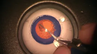 Simulated Surgery: Phacoemulsification: Creating Incision and Performing a Capsulorhexis