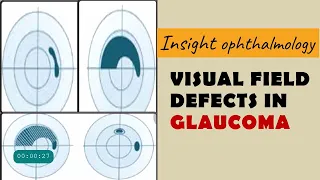 FIELD DEFECTS IN GLAUCOMA | arcuate, paracentral, nasal step, temporal wedge, baring of blindspot...