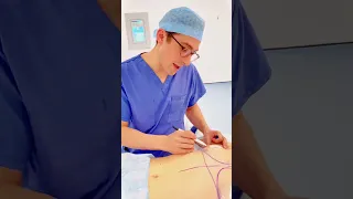 Breast Augmentation Dual Plane Technique - under the muscle & under the breast tissue