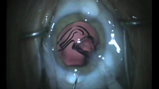 RayOne Trifocal (RAO603F) implantation by Mr Allon Barsam (UK)
