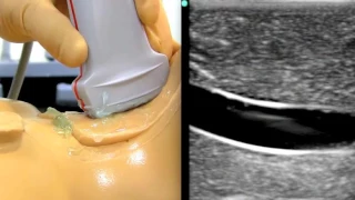 Ski Lift: a method to help in plane ultrasound needle guidance