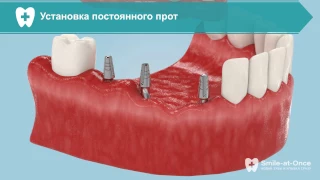 Восстановление жевательных зубов имплантами с немедленной нагрузкой