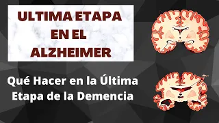 Qué Hacer en la Última Etapa de la Enfermedad de Alzheimer