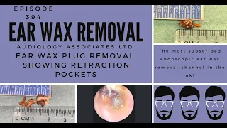 EAR WAX PLUG REMOVAL SHOWING RETRACTION POCKETS - EP394