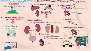 Polycythemia - Part 2