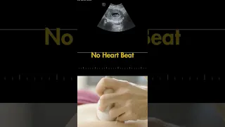 Ultrasound showing a  9 weeks fetus with no Heart Beat