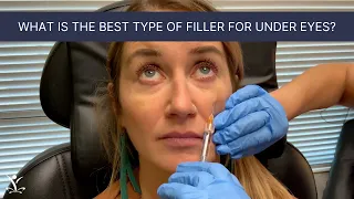 Treating Tear Troughs / Dark Circles with Filler