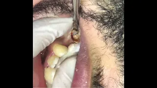 extraction of remaining root upper second premolar