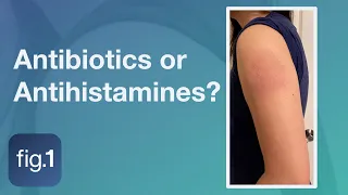 Should you treat 'COVID Arm' with antihistamines?